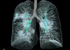 ct-chest-coronavirus-2019