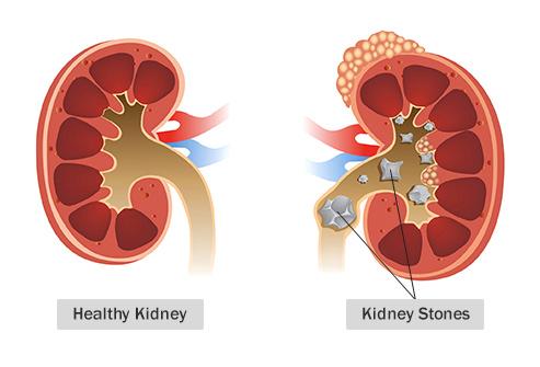 what-are-kidney-stones